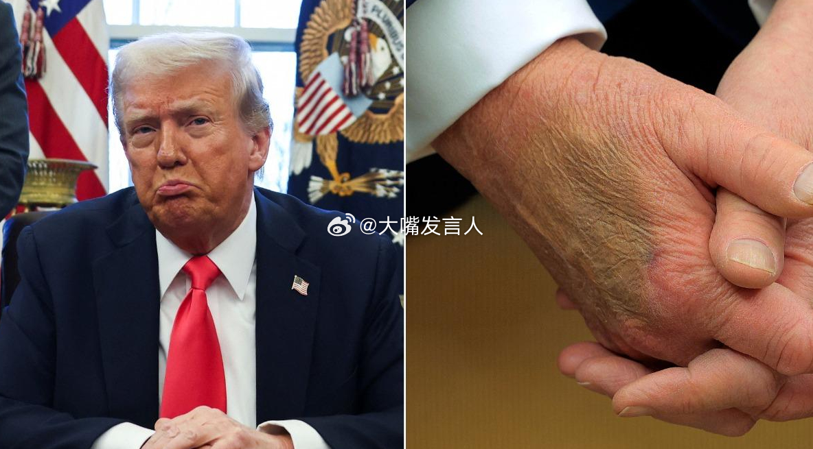 特朗普左手又添\"新淤青\" 白宫回应特朗普左手又添新淤青，白宫回应背后的故事